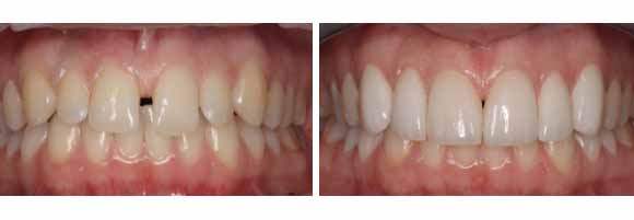 dental crowns