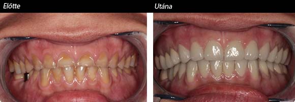 dental bridges