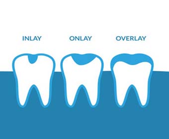 inlay onlay overlay fillings