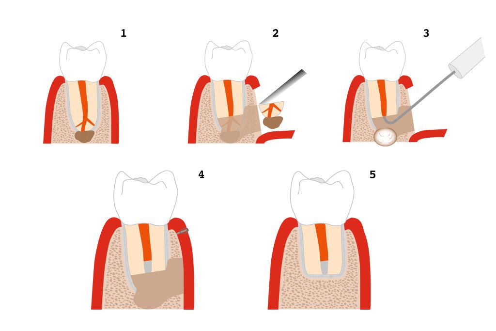 root-tip resection