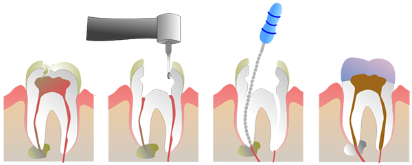 root canal treatment